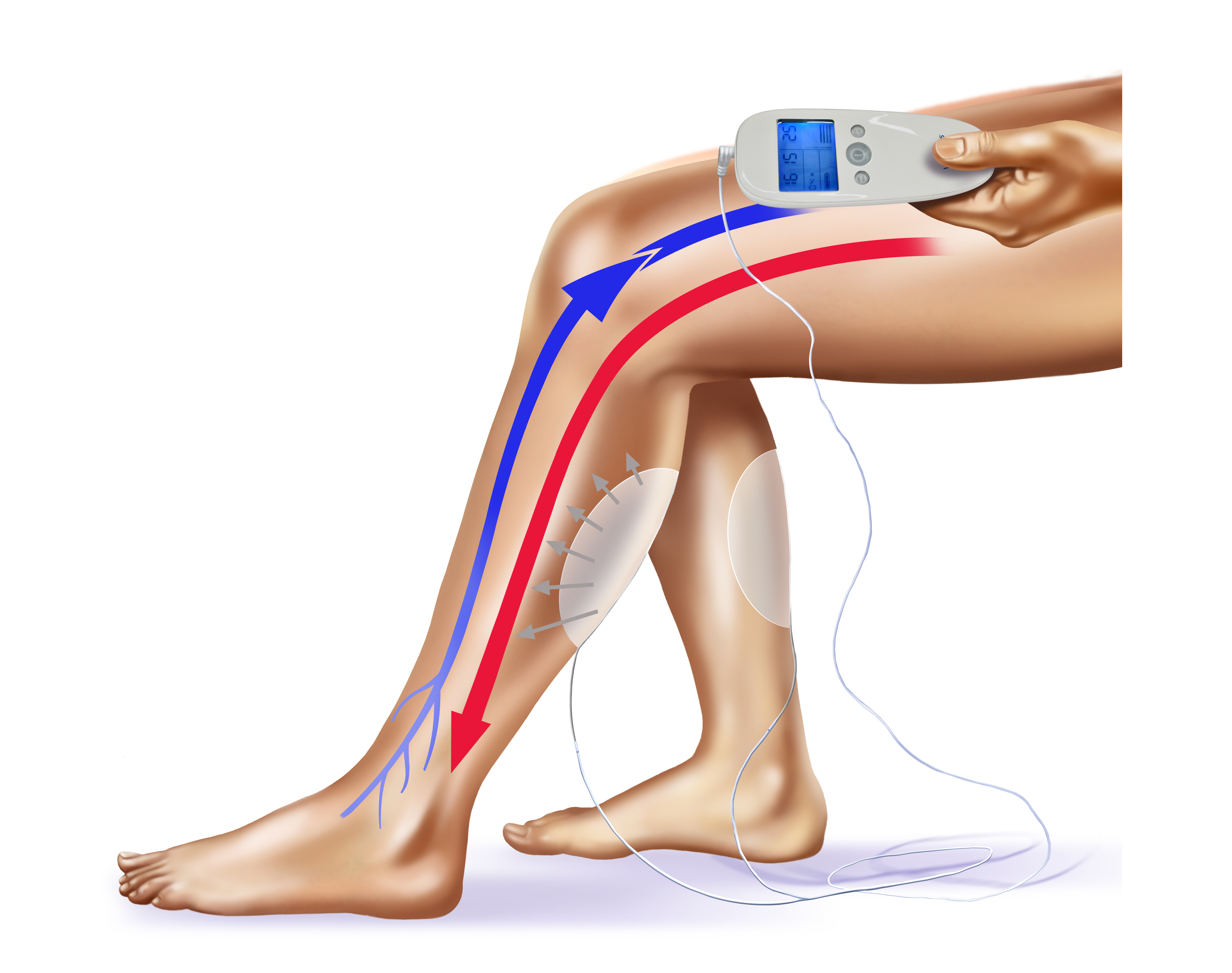 Calf Muscle Electrode Pad Placement