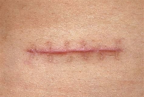 Pain, Inflammation Relief and Scar Reduction